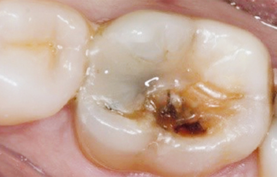 Výchozí stav: pohled na okluzální plošku dolního prvního moláru. BTW RTG snímek zachycující výchozí stav. V předloženém případě byl v souladu s pokyny pro minimálně invazivní preparaci ponechán kazem zasažený dentin v centrální části kavity. 