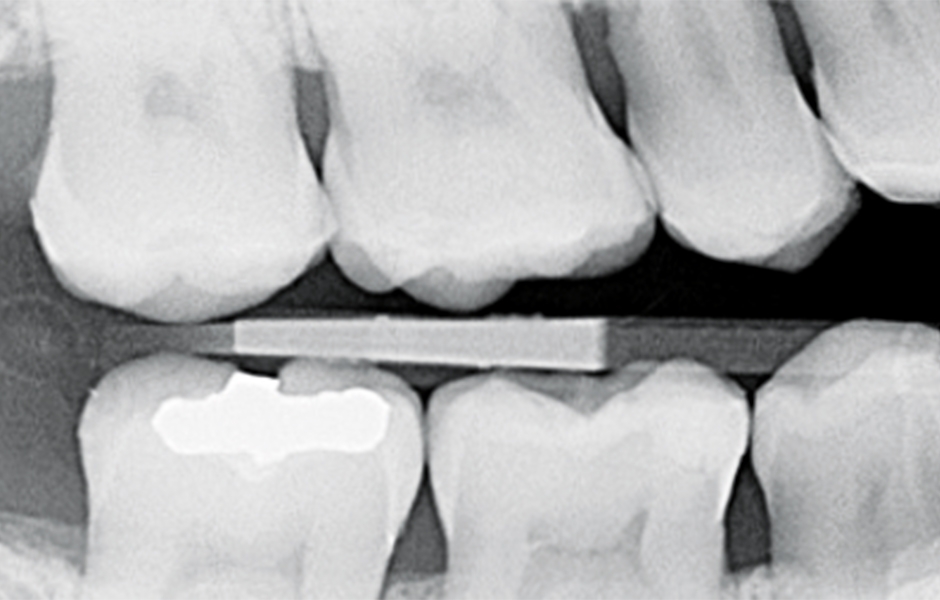 Výchozí stav: pohled na okluzální plošku dolního prvního moláru. BTW RTG snímek zachycující výchozí stav. V předloženém případě byl v souladu s pokyny pro minimálně invazivní preparaci ponechán kazem zasažený dentin v centrální části kavity.