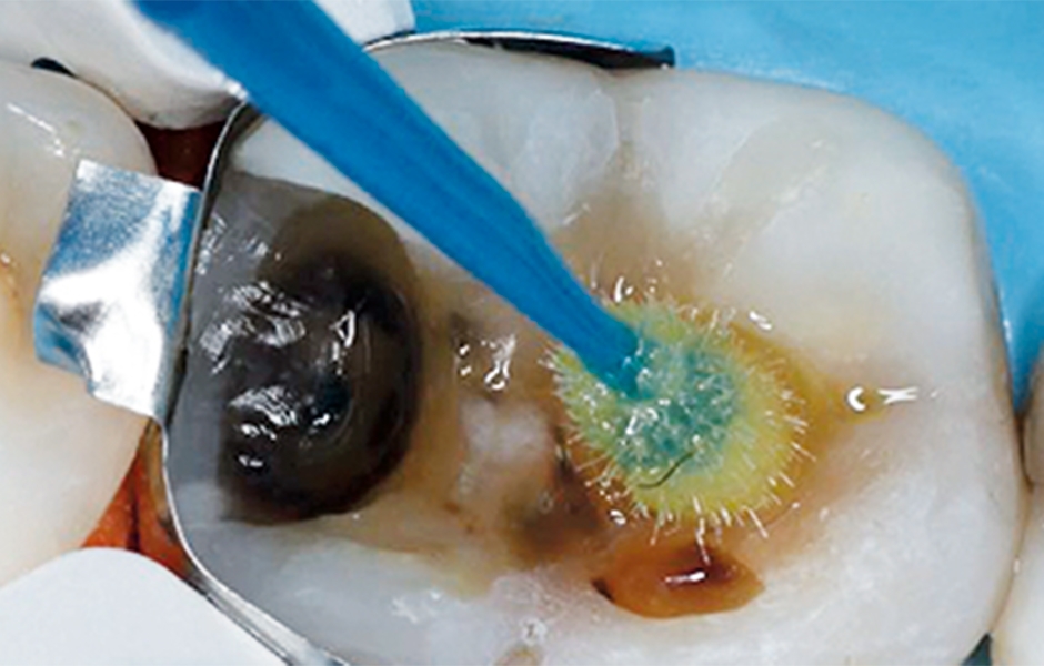 Výchozí stav: pohled na okluzální plošku dolního prvního moláru. BTW RTG snímek zachycující výchozí stav. V předloženém případě byl v souladu s pokyny pro minimálně invazivní preparaci ponechán kazem zasažený dentin v centrální části kavity.