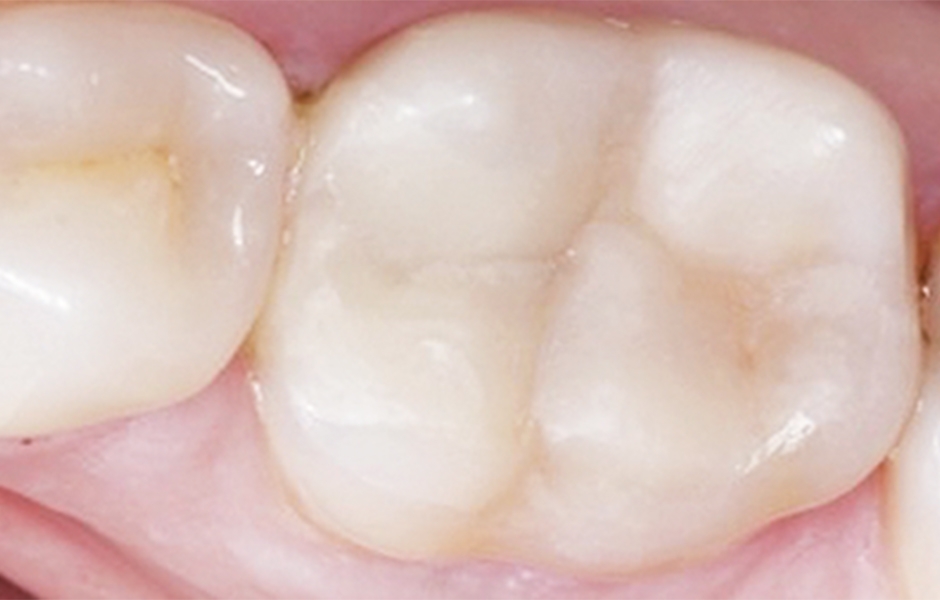 Dostavba aproximální stěny za použití systému sekčních matric. Pohled na okluzální plošku zubu před zaleštěním výplňového materiálu. Při kontrole po jednom měsíci bylo provedeno klinické vyšetření inkriminovaného zubu a zároveň byl proveden i test vitalit