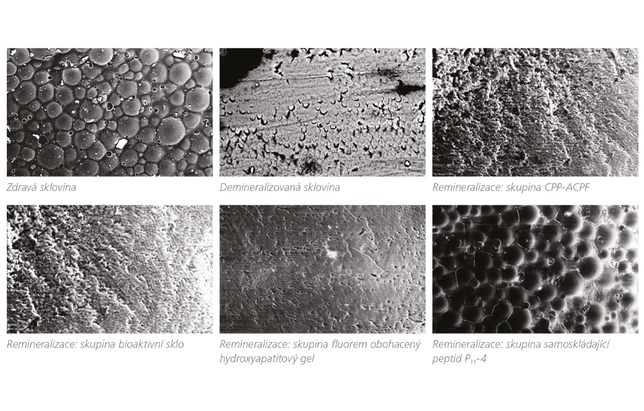 Hodnocení remineralizace skloviny po ošetření čtyřmi různými remineralizačními činidly: studie pomocí skenovací elektronové mikroskopie (SEM)