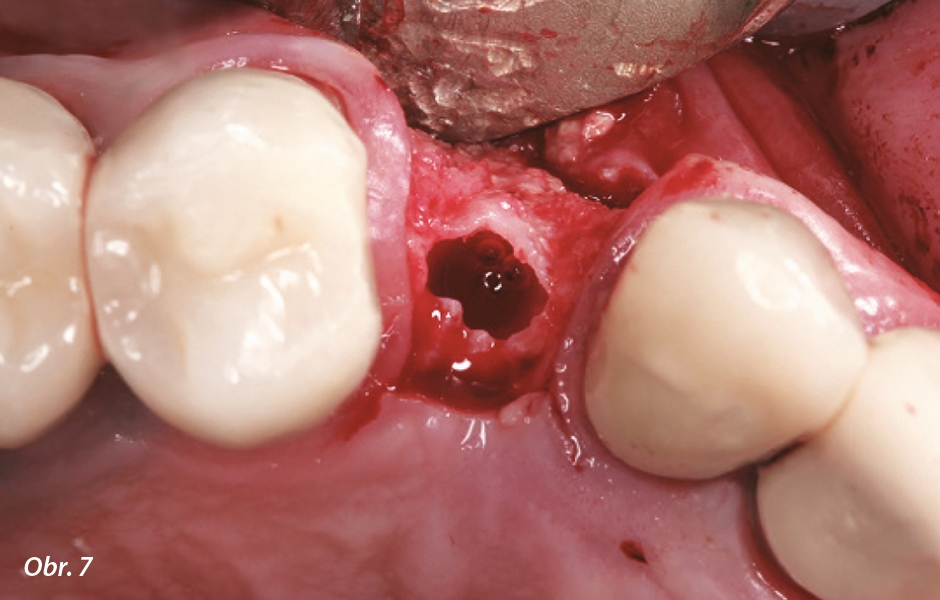 Oseodenzifikace usnadnila rozšíření alveolárního hřebene pro provedení 3,8mm osteotomie.