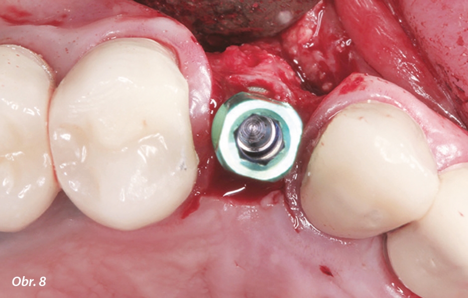 V oblasti zubu 13 byl zaveden implantát 4,2/13 mm.