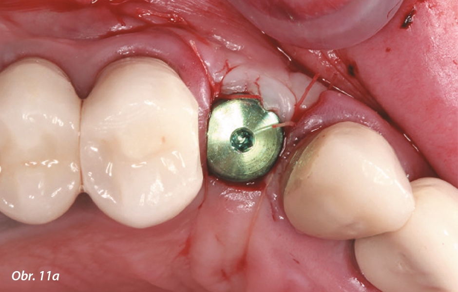 K augmentaci měkkých tkání z bukální strany implantátu v oblasti zubu 13 byla použita technika Modified Role Soft Tissue Augmentation.