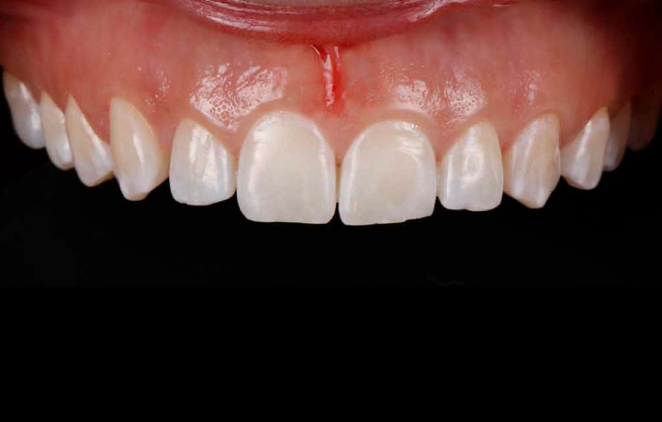 Obr. 3: Zobrazení opotřebovaných zubů, mezer a neideálních proporcí zubů a dásní.