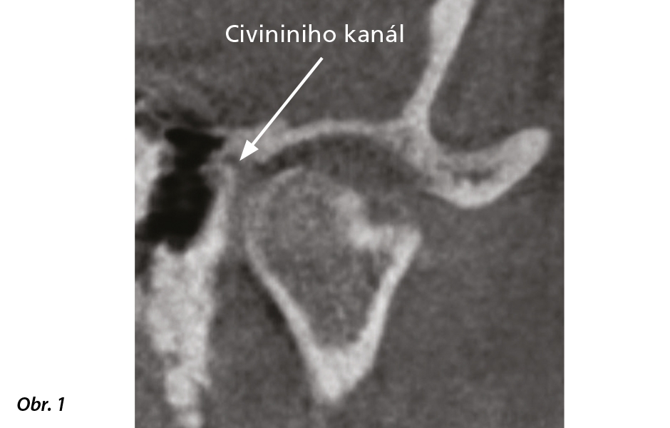 Obr. 1a: ATM CT sken, kde je zvýrazněn Civininiho kanál, spojující temporomandibulární kloub s dutinou středního ucha.