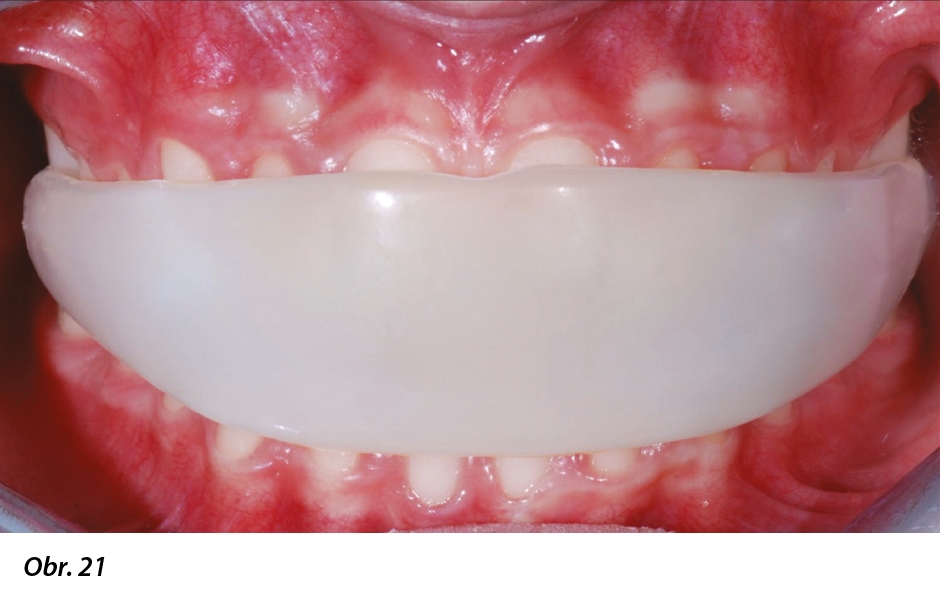 Obr. 21: Elastodontický aparát se žvýkací dlahou.