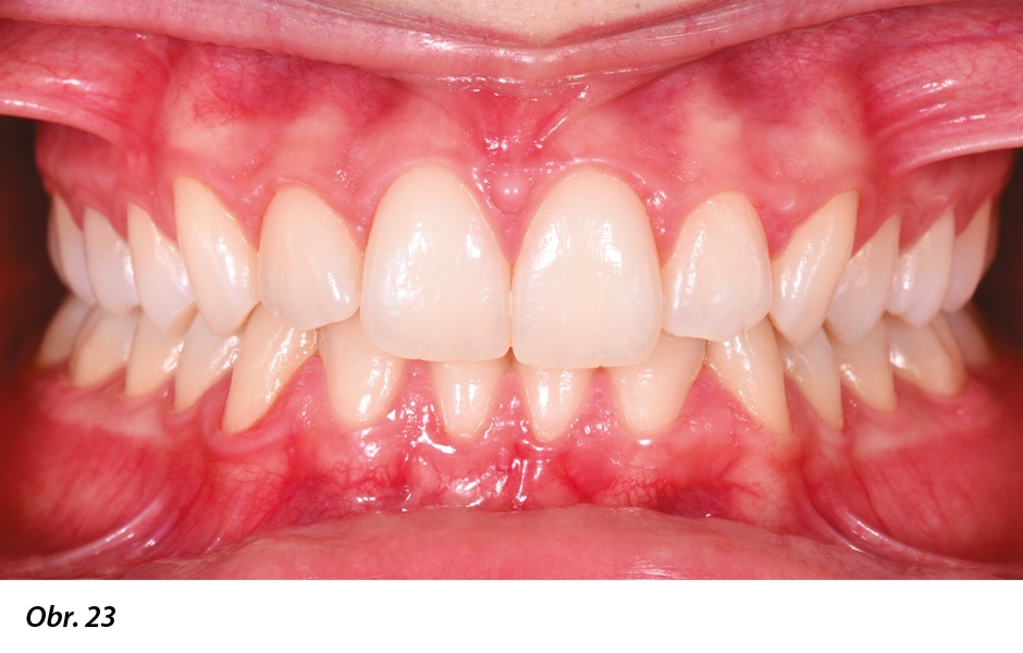 Obr. 23: Intraorální fotografie na konci terapie: obnovení vertikálního rozměru a vyřešení stěsnání zubů, parodont se zhojil 