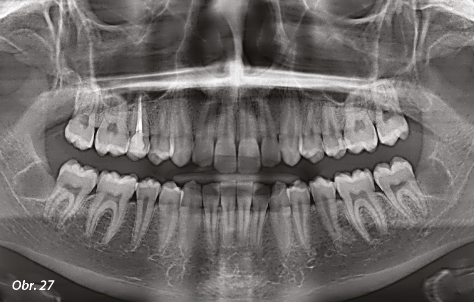 Obr. 27: Finální ortopantomogram. 