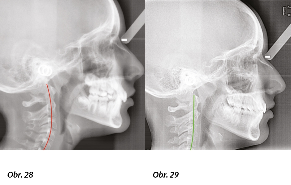 Obr. 28: Počáteční telerentgen s evidentním retruzním postavením dolní čelisti a kompresí krčních obratlů. Obr. 29: Závěrečný telerentgen s obnovením polohy dolní čelisti a vyrovnáním cervikální křivky.
