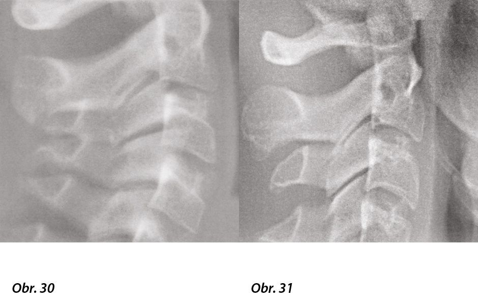 Obr. 30: Detail z počátečního telerentgenu, který ukazuje zmenšení meziobratlového prostoru mezi C2–C3, Obr. 31: Detail ze závěrečného telerentgenu, který ukazuje zvětšení meziobratlového prostoru.