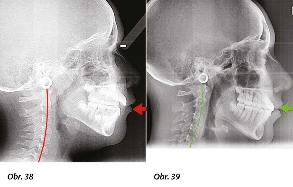Obr. 38: Úvodní telerentgen s patrnou změněnou křivkou krčních obratlů, Obr. 39: Konečný telerentgen s evidentním zlepšením v oblasti krku.