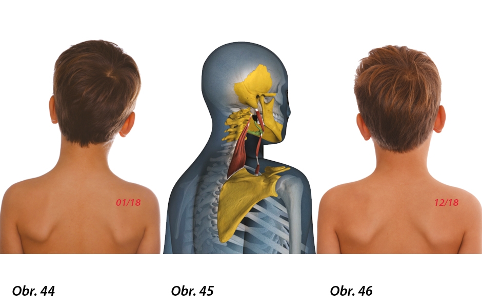 Obr. 44: Posturální alterace patrná z odlišné polohy lopatek. Obr. 45: Trojrozměrný snímek, který zvýrazňuje těsnou anatomickou korelaci mezi dolní čelistí, jazylkou a lopatkou. Obr. 46: Fotografie zad.