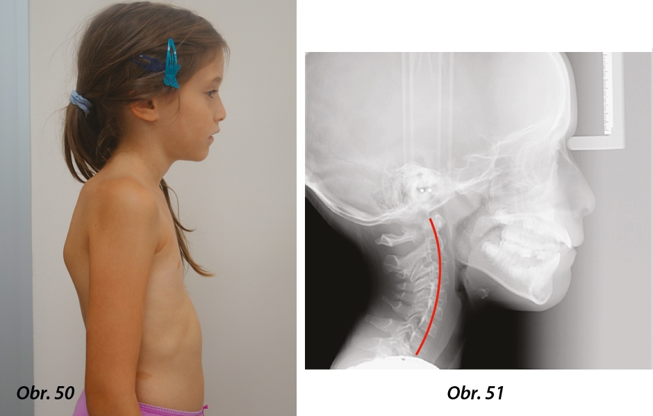 Obr. 50: Snímek držení těla pacienta s otevřeným skeletálním a dentálním skusem, Obr. 51: Počáteční telerentgen, na kterém je vidět rotace dolní čelisti a následné stlačení krčních obratlů