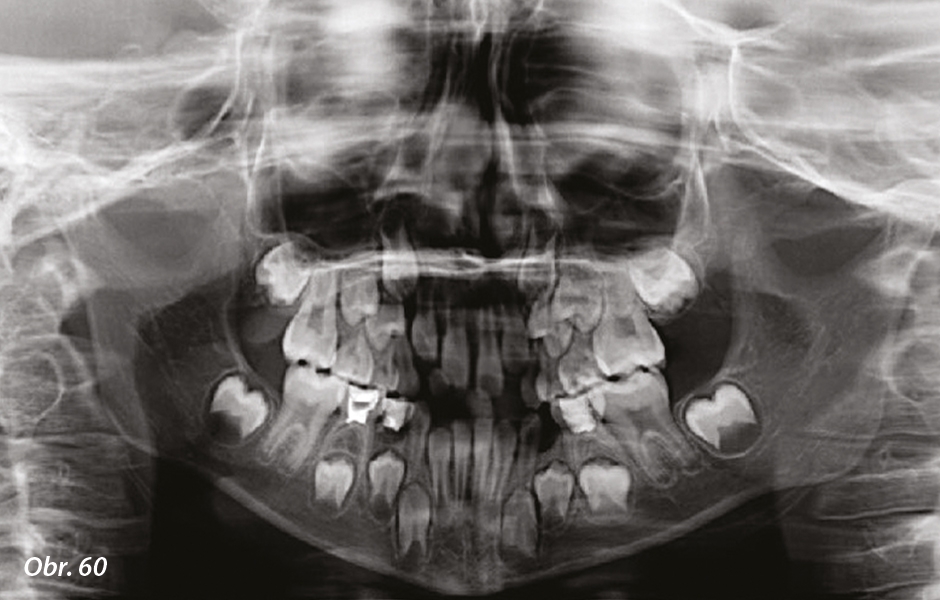 Obr. 60: Úvodní ortopantomogram: stěsnání v horním zubním oblouku