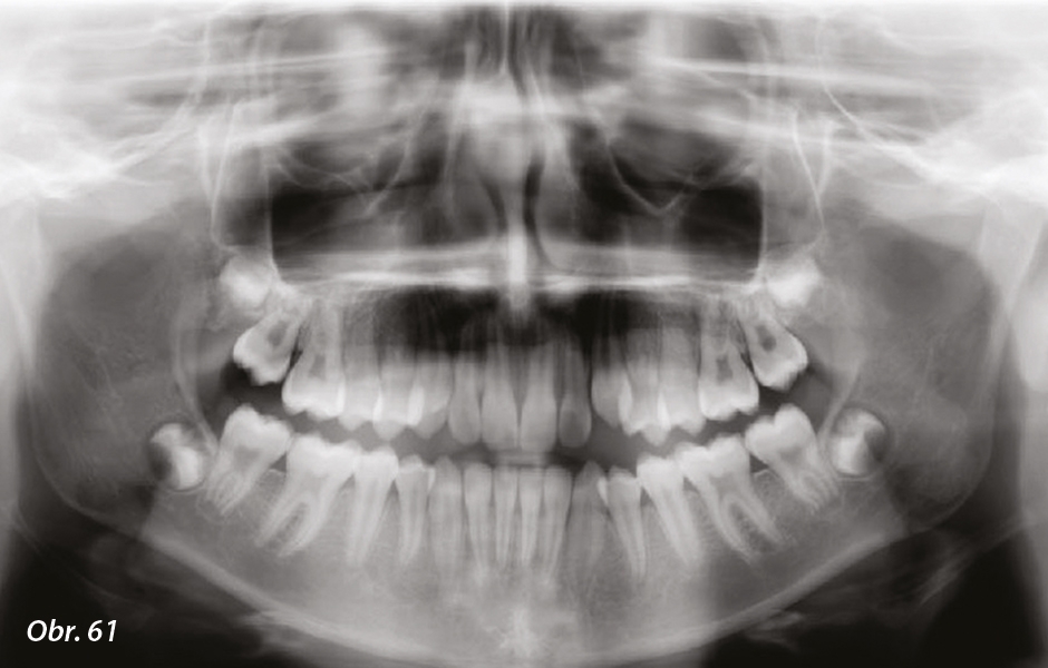 Obr. 61: Ortopantomogram na konci terapie: obnova fyziologického prostoru pro zuby.