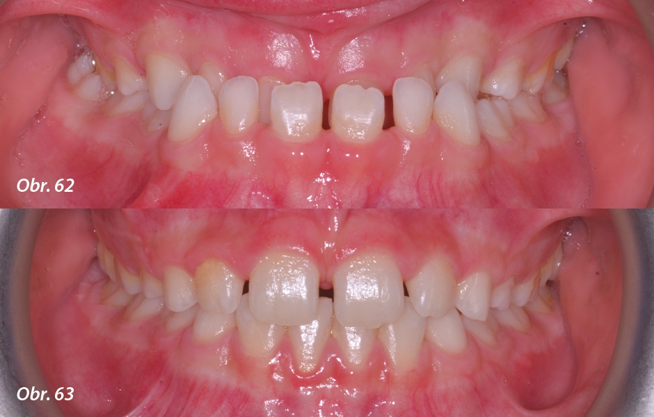 Obr. 62: Frontální intraorální fotografie: těžká skeletální a dentální III. třída, Obr. 63: Vyřešení malokluze po 12 měsících elastodontické terapie