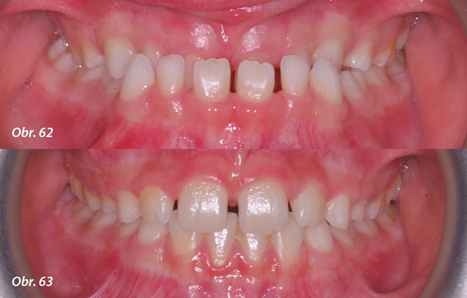 Obr. 62: Frontální intraorální fotografie: těžká skeletální a dentální III. třída. Obr. 63: Vyřešení malokluze po 12 měsících elastodontické terapie.