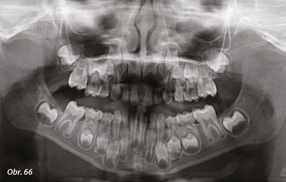 Obr. 66: Úvodní ortopantomogram: stěsnání horního zubního oblouku se zmenšením prostoru pro správné prořezání horních stálých řezáků