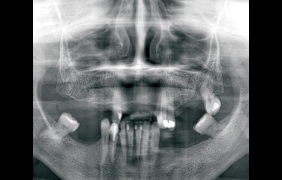 Úvodní panoramatický rentgenový snímek pacientky.