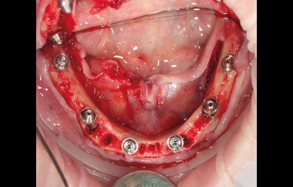 GM Mini Conical abutmenty na implantátech po dotažení momentem 32 Ncm. 