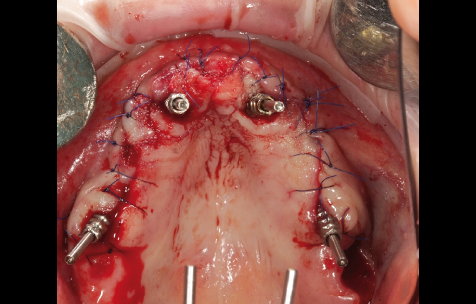 Stav v horní čelisti po sutuře se zavedenými otiskovacími piny.