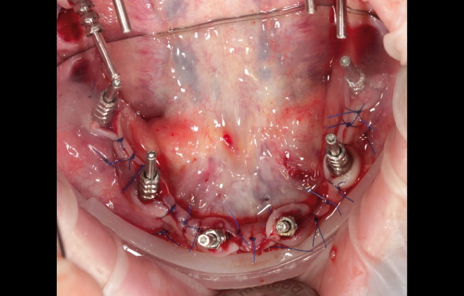 Stav v dolní čelisti po sutuře se zavedenými otiskovacími piny, okluzní pohled.