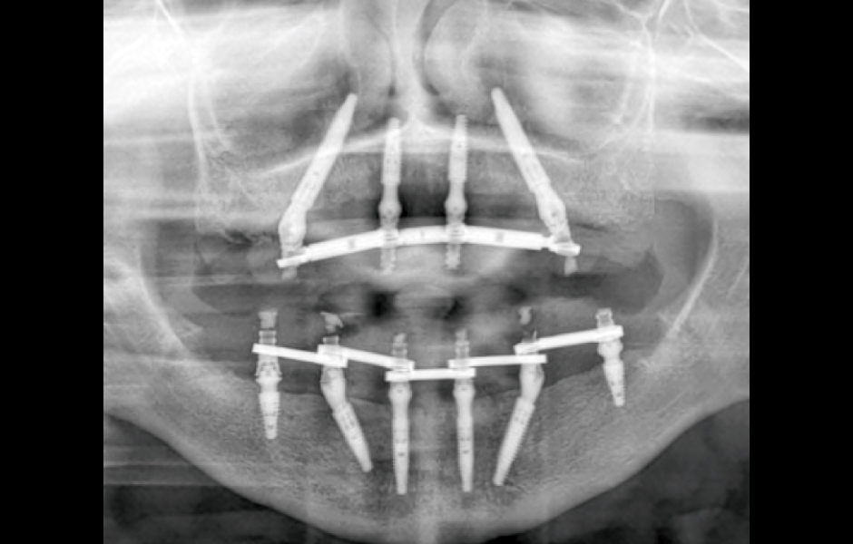 Ortopantomogram se zavedenými Helix GM® implantáty.
