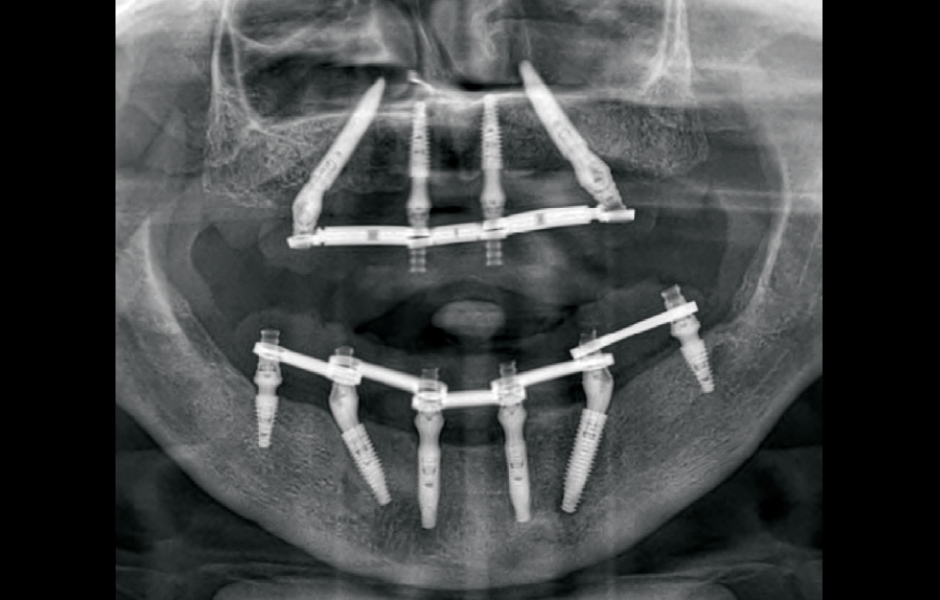 Ortopantomogram zhotovený 18 měsíců po zavedení implantátů.