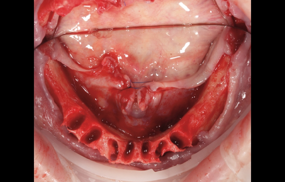 Odklopené mukoperiostální laloky v dolní čelisti před úpravou alveolu.