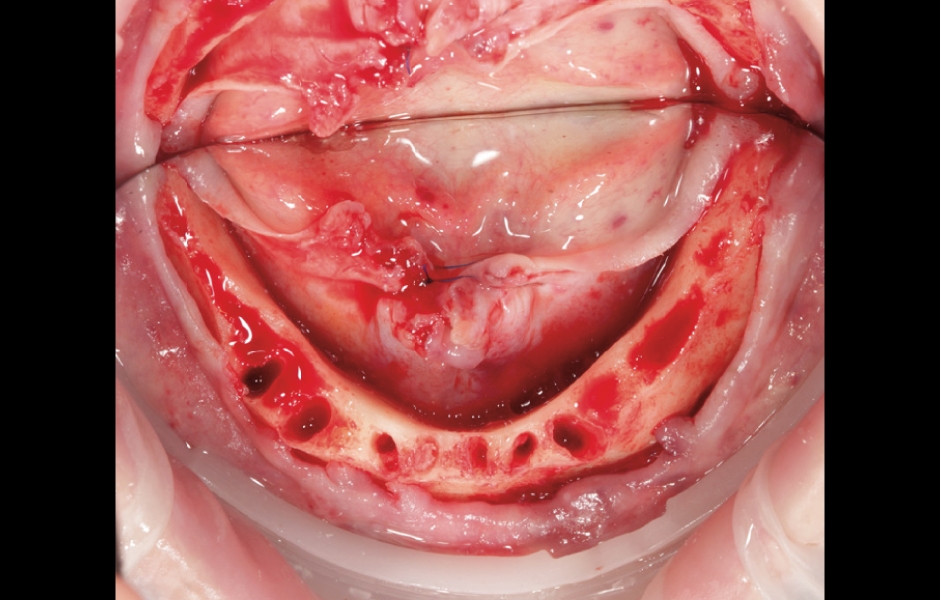 Situace v dolní čelisti po osteoplastice alveolu.