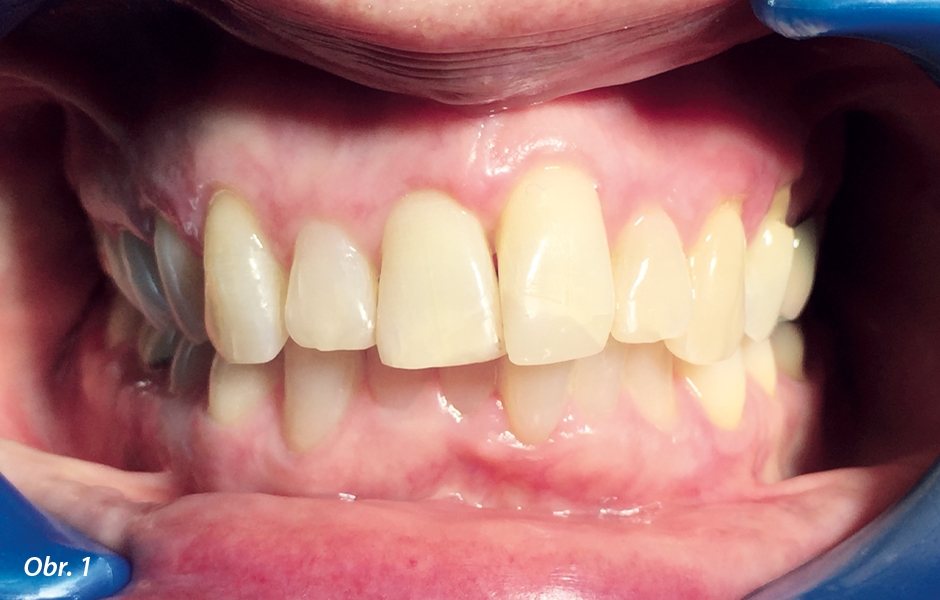 Klinická výchozí situace. Endodonticky ošetřené zuby 11–22 po úrazu. Proteticky mají být ošetřeny zuby 12–22 (zdroj: zubní lékařka Swantje Matthes).