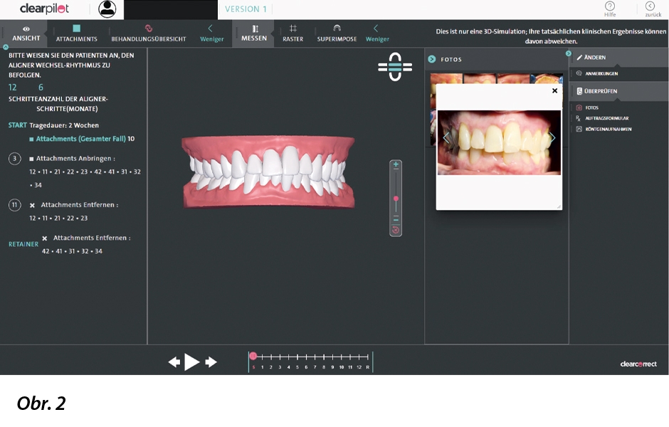 Software ClearPilot pro 3D plánování ošetření (zdroj: Straumann Group).