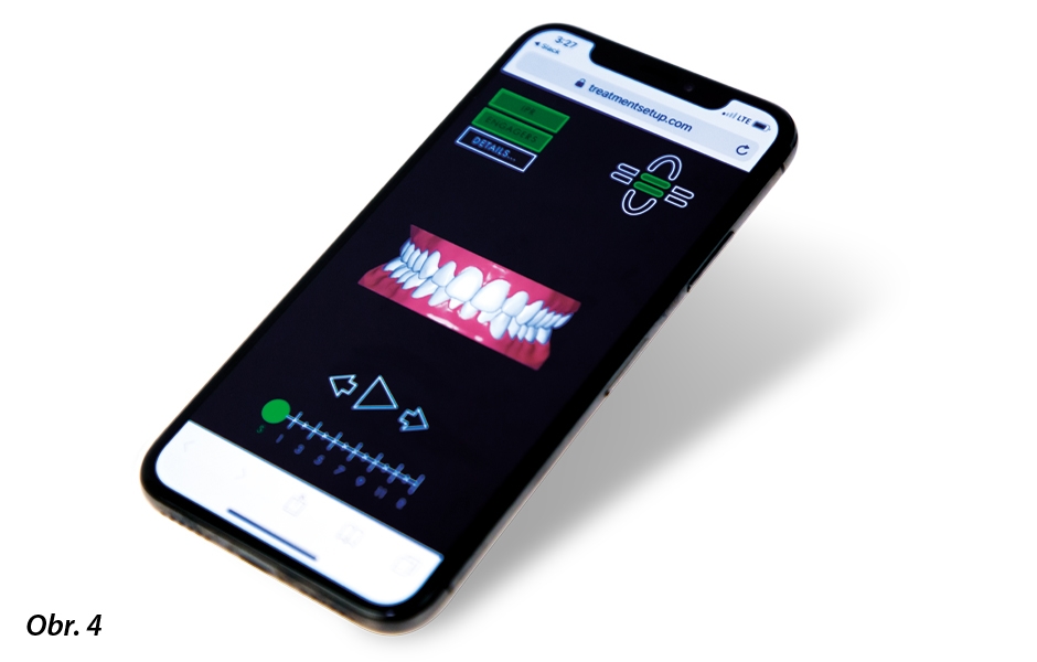 Cílový stav jako náhled na mobilním telefonu: Plánování každého případu zahrnuje 3D simulaci optimalizovanou pro mobilní telefony a možnost jejího zaslání pacientovi jako odkaz e-mailem (zdroj: Straumann Group).