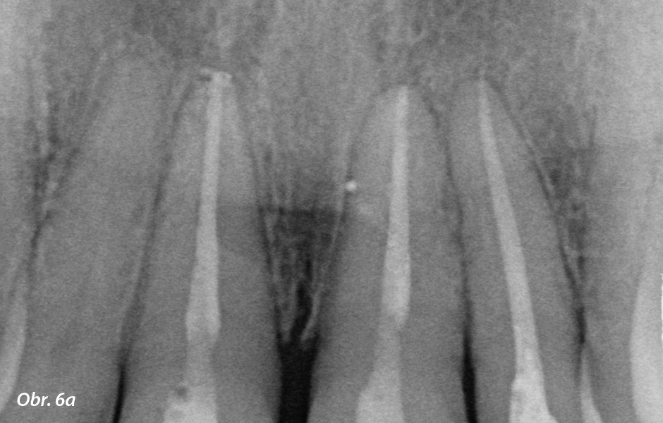 Kontrolní snímky předních zubů horní a dolní čelisti před preparací (zdroj: zubní lékařka Swantje Matthes).