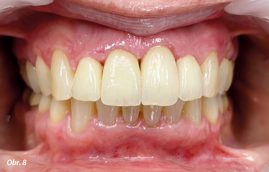 Výsledek ošetření pomocí ClearCorrect a protetické léčby zubů 12–22. Stěsnání zubů v dolní čelisti bylo úspěšně vyřešeno, takže bylo možno optimálně ošetřit horní čelist (zdroj: zubní lékařka Swantje Matthes).