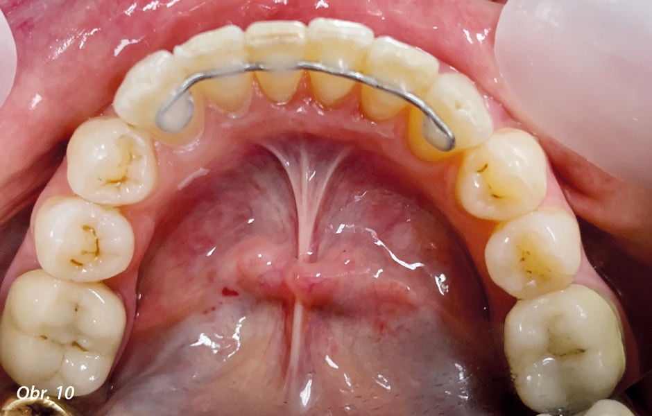 Vyrovnaný zubní oblouk horní čelisti po ukončení ošetření pomocí ClearCorrect a protetickém ošetření. V současnosti pacientka používá na noc dlahy (retainery) pro zachování dosaženého stavu (zdroj: zubní lékařka Swantje Matthes).