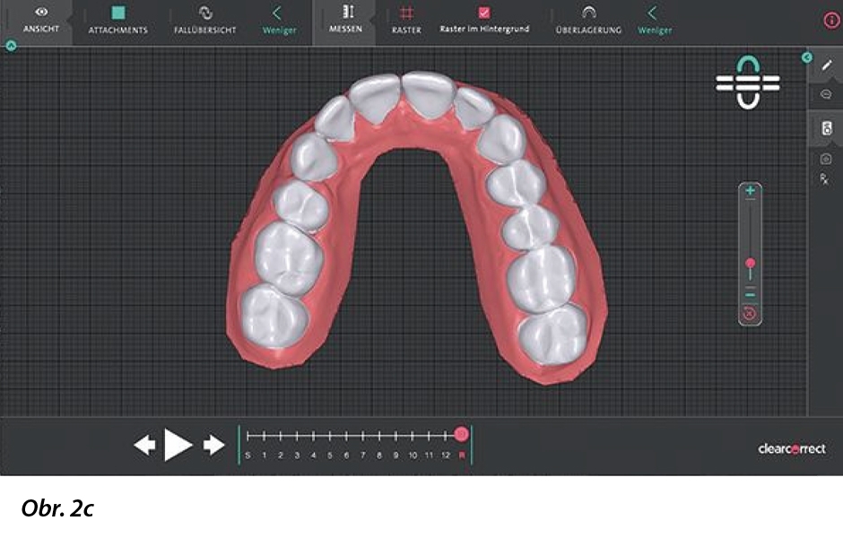 Digitální plán ošetření ukazuje nález a plánovaný konečný výsledek krok za krokem.