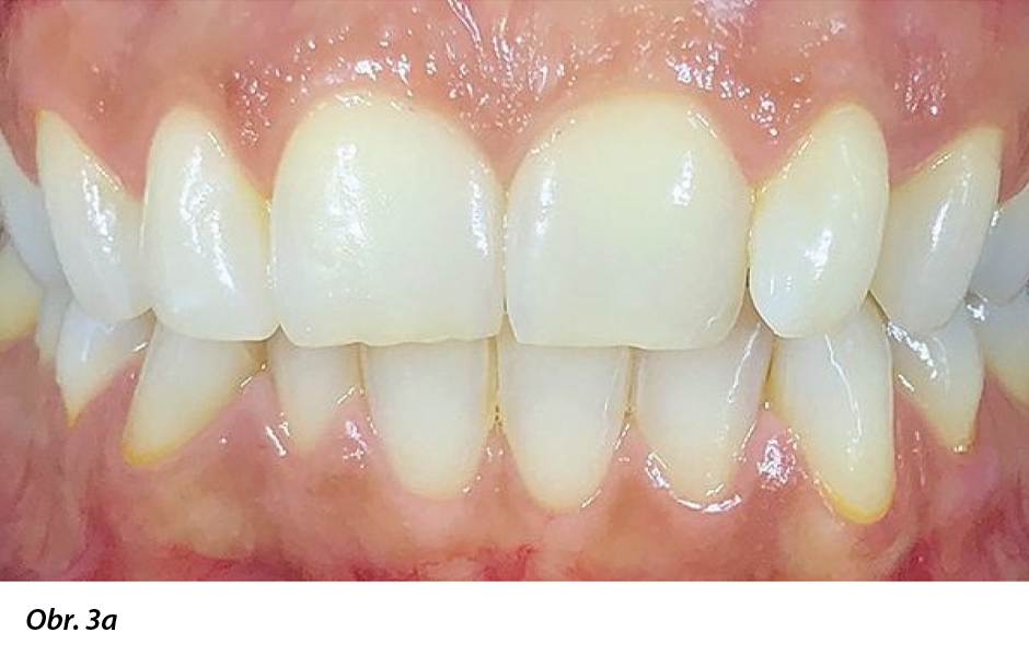 Meziální hrana zubu 22 funkčně omezovala pacientku při pohybu rtů.