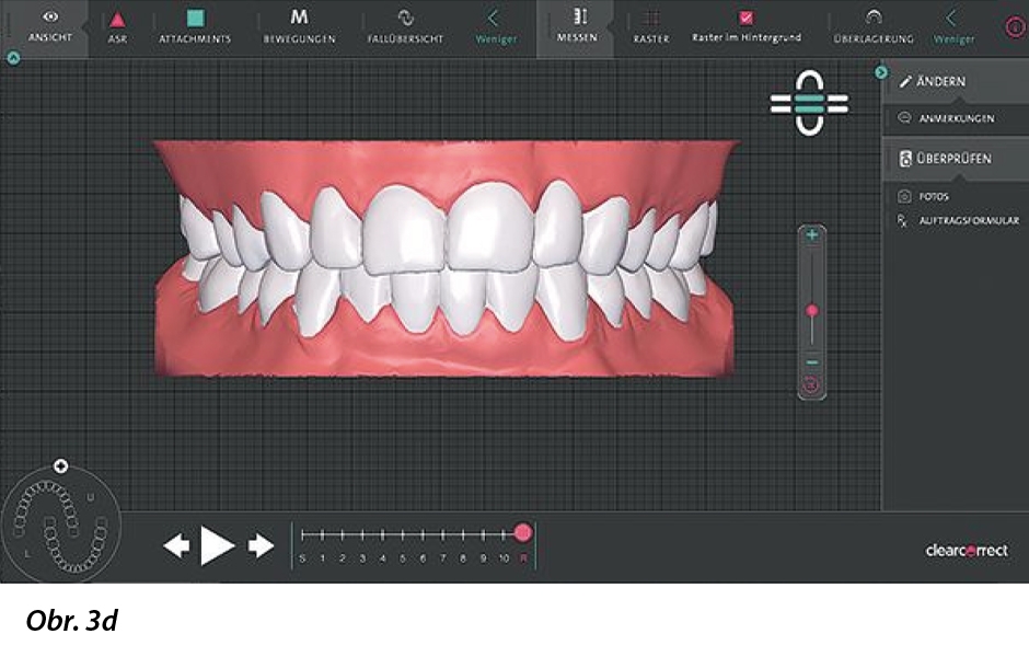 Díky digitálnímu otiskování a vysoké přesnosti při výrobě se dosahuje vysoké přesnosti přizpůsobení alignerů.