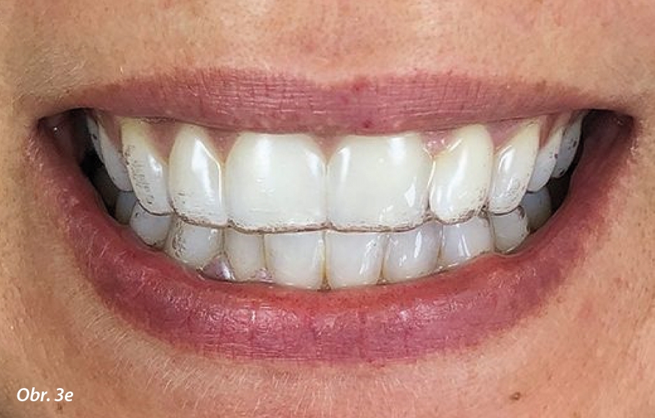 Pacientka s alignerem ClearCorrect. Obklopení celého zubu až přes dáseň umožňuje přesnější posunutí zubu a dobré usazení alignerů. Jsou téměř neviditelné, flexibilní a velmi robustní.