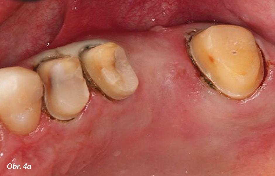Intraorální náhled preparovaných zubů 14, 15, 17 – je vidět dobré zhojení dásně při přípravě na sken.