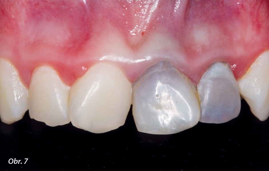 Obr. 7: Zbarvení korunek zubů po revaskularizaci