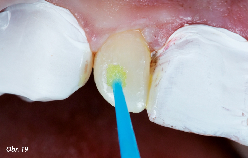 Stejný postup jako u zubu 21 jsem zopakoval i u ostatních zubů. Aplikace G–Premio BOND na zub 12.