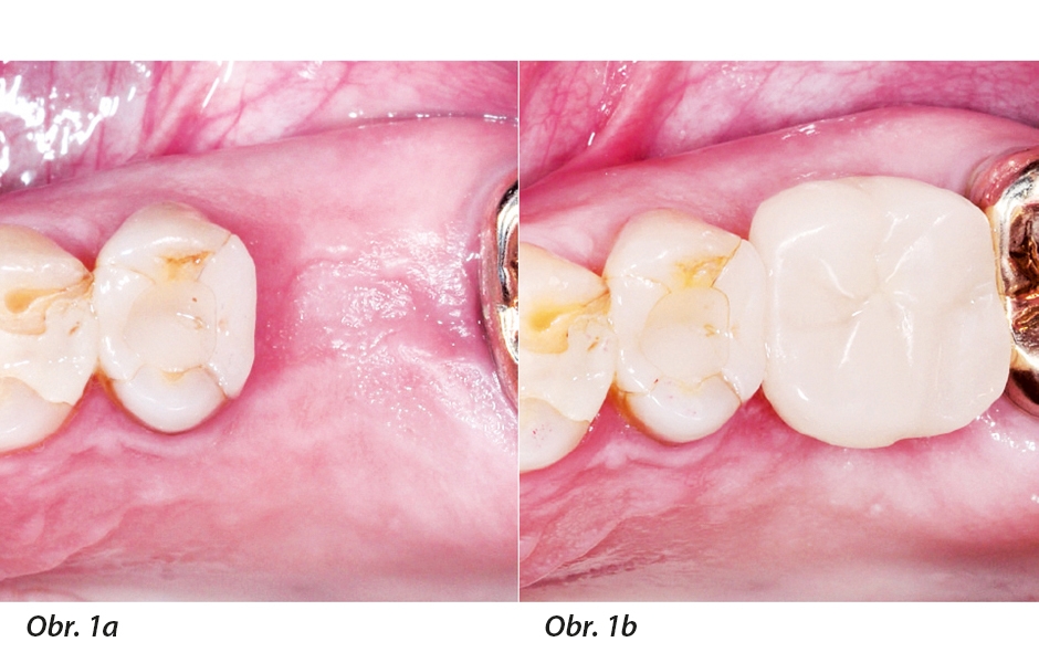 Obr. 1a: Počáteční situace: po extrakci zubu 26 a po fázi hojení; Obr. 1b: Výsledek ošetření: optimálně vhojený implantát a adaptovaná gingiva