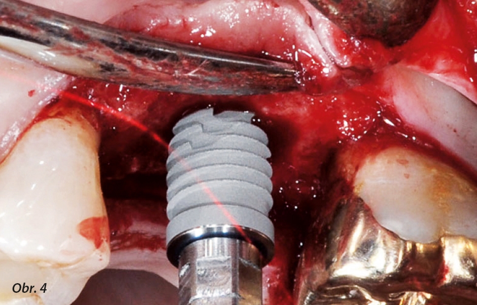 Implantát je zaveden do preparovaného kostního lože