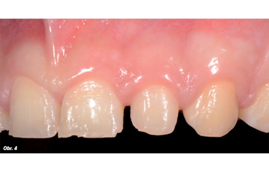 Počáteční stav klinického případu zachycující morfologii zubů v horním frontálním úseku a jejich vztah se rty a okolními tkáněmi