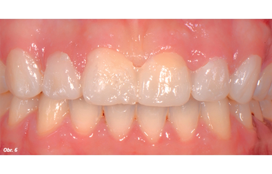 První mock-up, který nezahrnoval prodloužení klinické korunky na základě ostatních zubních prvků, nanesený na zuby ve formě kompozitní bisakrylátové pryskyřice a jeho vztah s parodontálními tkáněmi