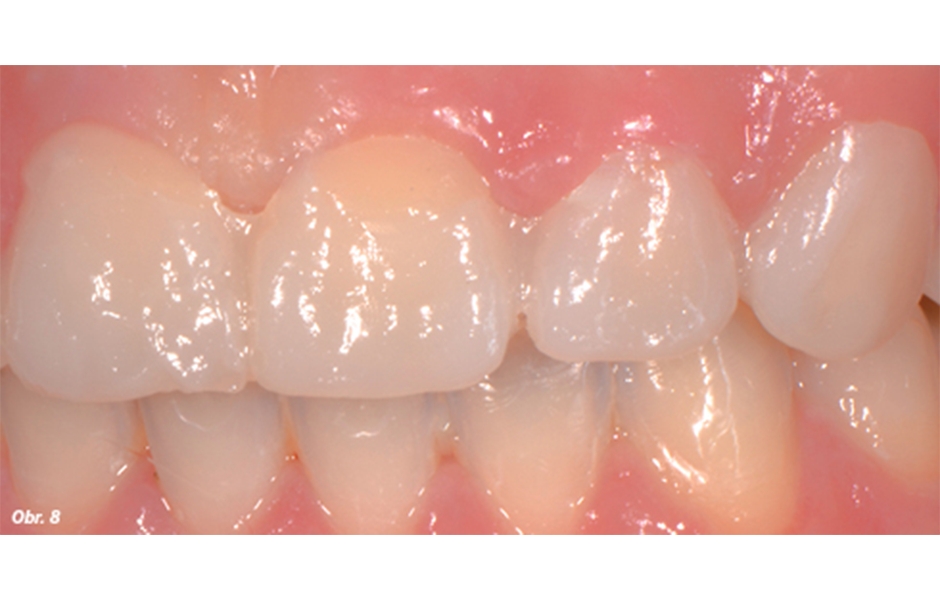 První mock-up, který nezahrnoval prodloužení klinické korunky na základě ostatních zubních prvků, nanesený na zuby ve formě kompozitní bisakrylátové pryskyřice a jeho vztah s parodontálními tkáněmi