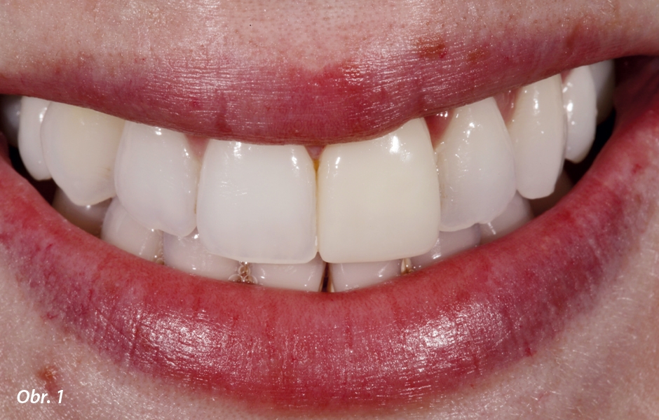  Po vybělení zubů vypadala kompozitní pryskyřičná korunka na zubu 21 neesteticky.